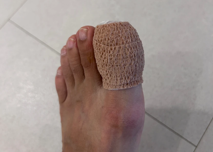엄지 발톱 멍 치료 후기, 정형외과 진료 약 처방